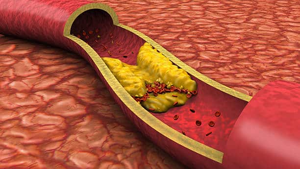 Cholesterols building up blood clots