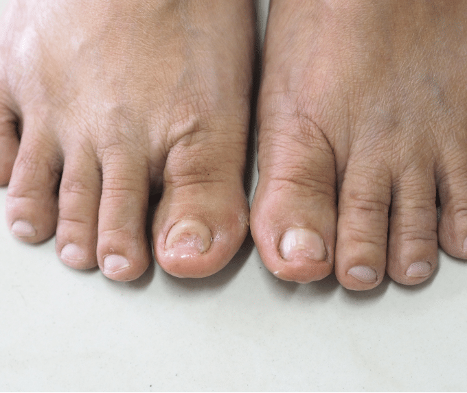 Feet with infection 