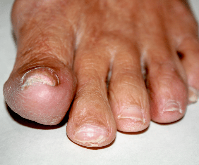 Foot with infection 