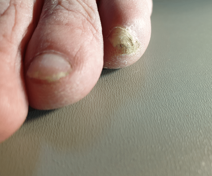Toe nail fungus 