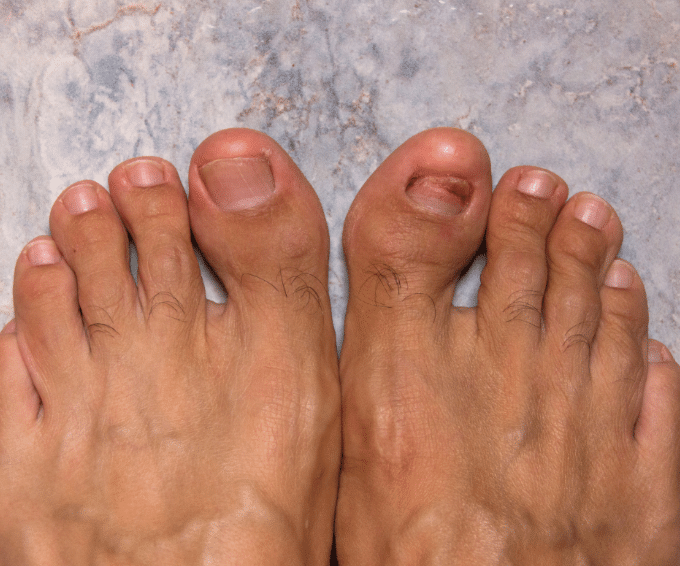 Toe nails with fungus 