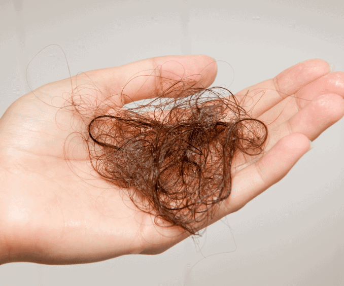 Hairloss