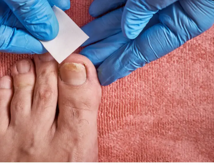 nurse treating toenail fungus with jublia